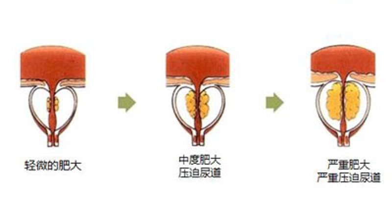 泌尿系结石与肾结石有什么区别?